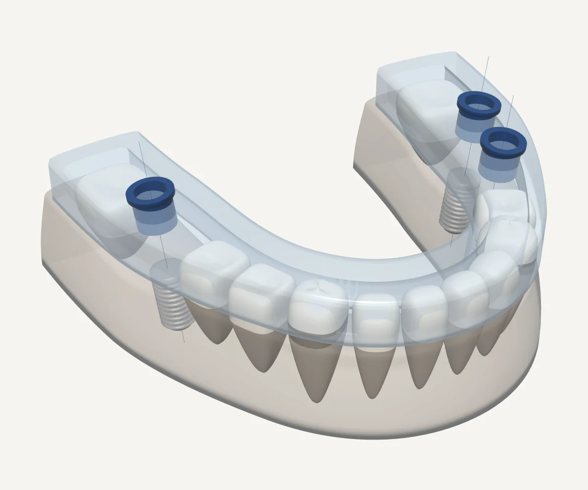 Synthetic example: a lower jaw with three planned implants, a sleeve above each one and a clear guide over the teeth. Not a patient case.