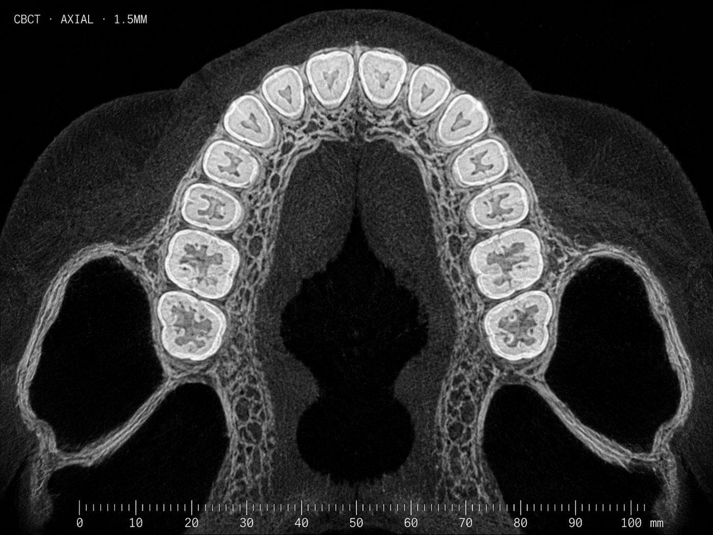 CBCT axial slice of a dental arch the planner works from